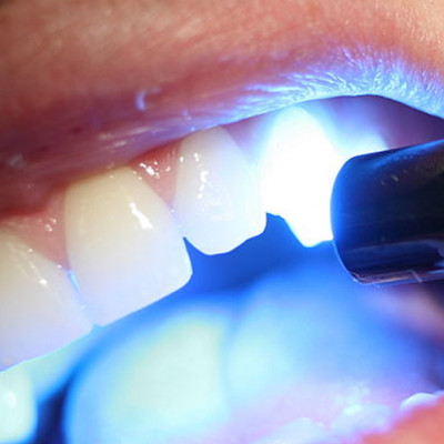 Фотополімерна пломба